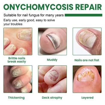 EELHOE Ulje Za liječenje Onychomycosis Noktiju nokte Na Nogama Uklanjanje Gljivične Infekcije Noktiju Ljekovito Эссенция Tekućina Za njegu noktiju na nogama